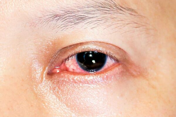 Conjunctivitis 