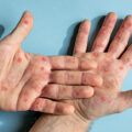 Mpox Virus Outbreak - News for Kids