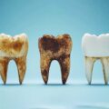 What Are Dental Cavities? 