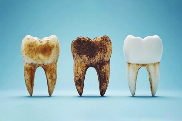 What Are Dental Cavities? 