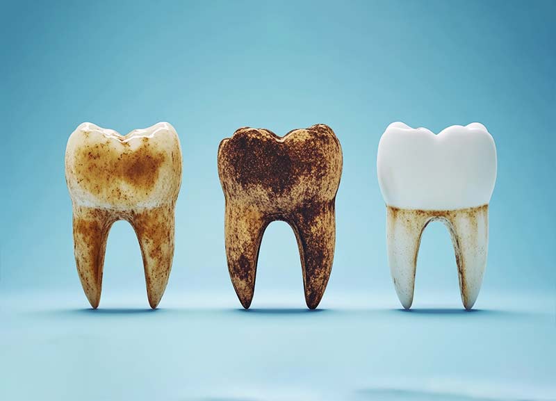 What Are Dental Cavities? 