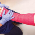 Fixing Fractures With Adhesives - News for Kids