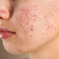 Can What You Eat Affect Your Acne?