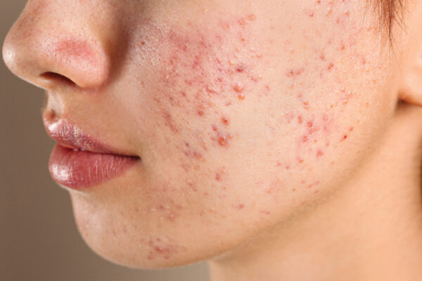Can What You Eat Affect Your Acne?